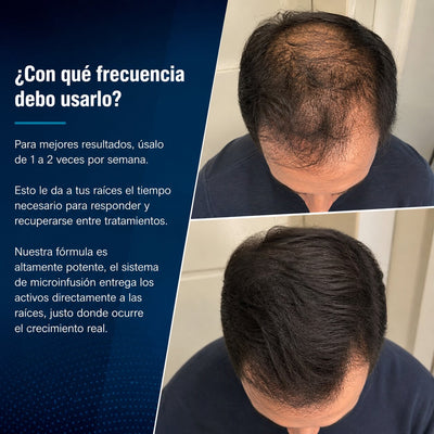 Alfavita™ Sistema Regeneración Capilar (2 meses)